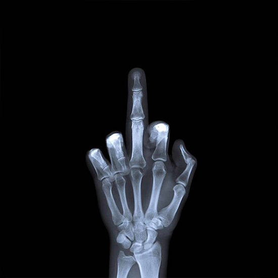 x-ray middle finger